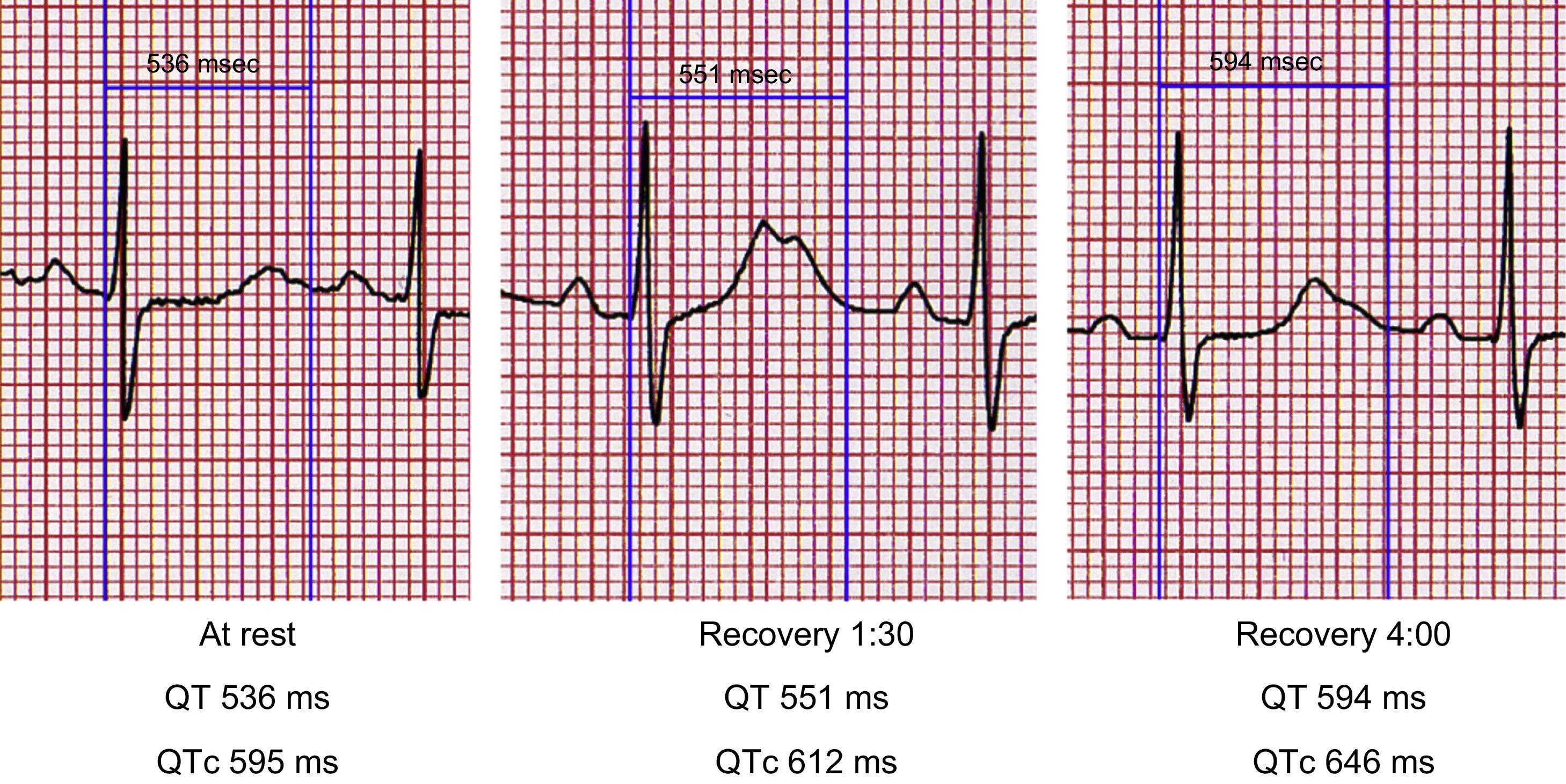 Response to ECG, June 2018 - Revista Española de Cardiología (English ...