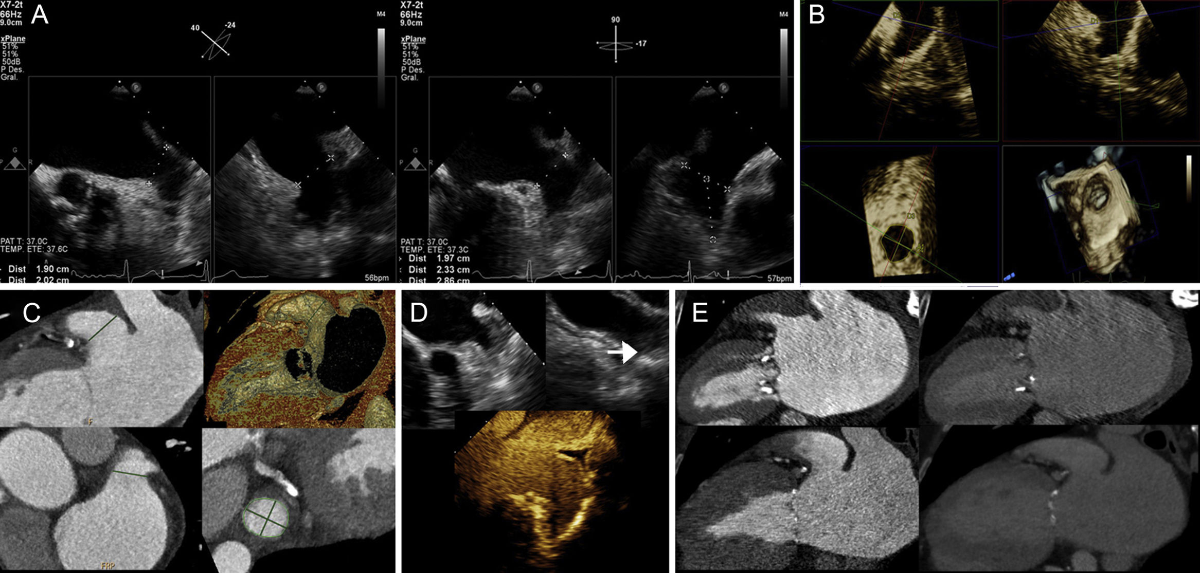 Percutaneous Left Atrial Appendage Occlusion: Multimodality Imaging ...