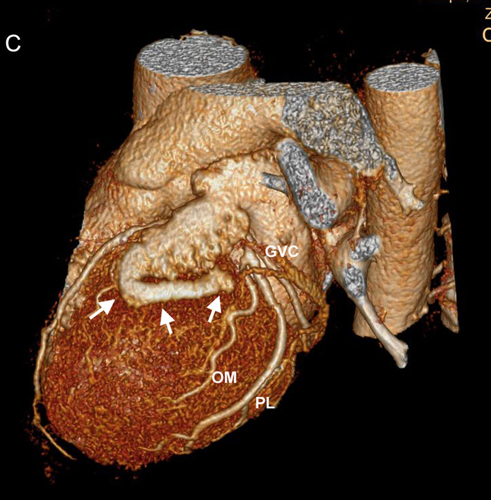 Congenital Fistula of the Left Atrial Appendage | Revista Española de ...