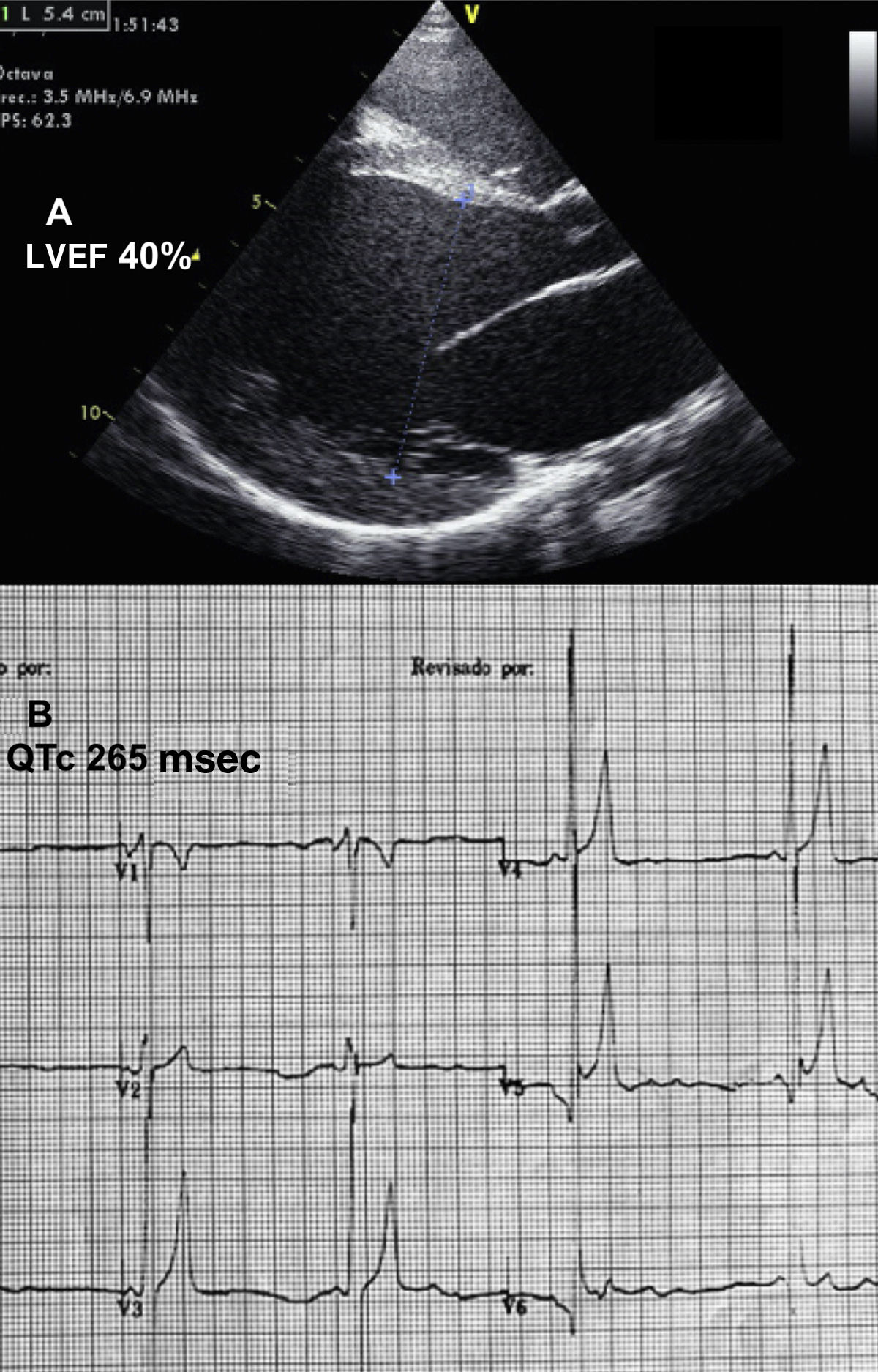 l carnitine heart arrhythmia TRANSPORT AND FATTY ACID OXIDATION Didn't another study show carnitine
