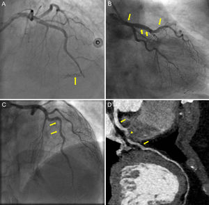 Coronary angiography showing mid-LAD perforation (panel A, arrow). Dissection flap extending from mid-LAD up to the left main illustrated in CA (panel B, C, arrows) and in computed tomography CA (panel D, arrows), with intramural hematoma causing minimal stenosis in mid-LAD (panel D, arrowhead). CA, coronary angiography; LAD, left anterior descending.