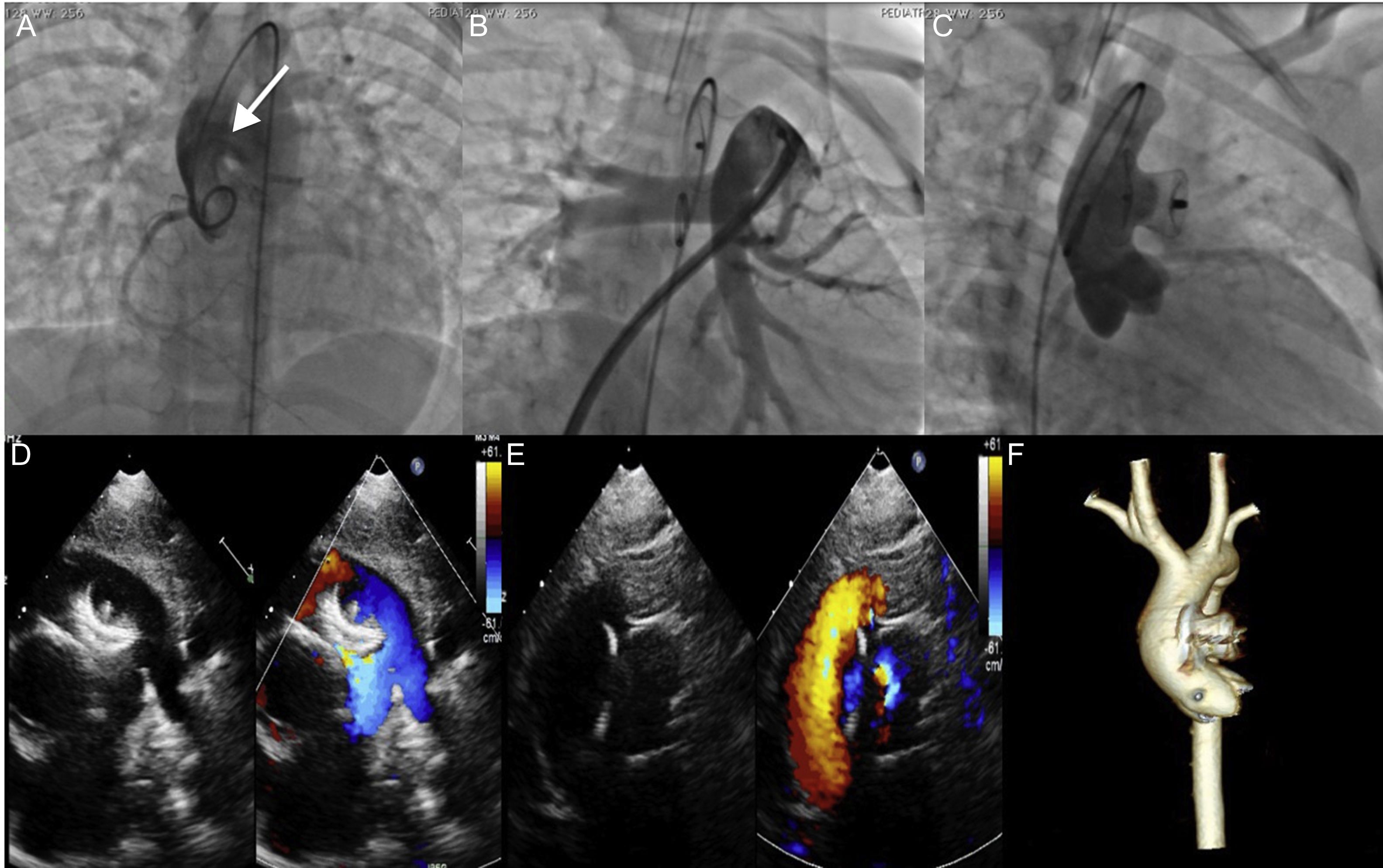 Transcatheter Device Closure of Aortopulmonary Window. Is There a Need ...