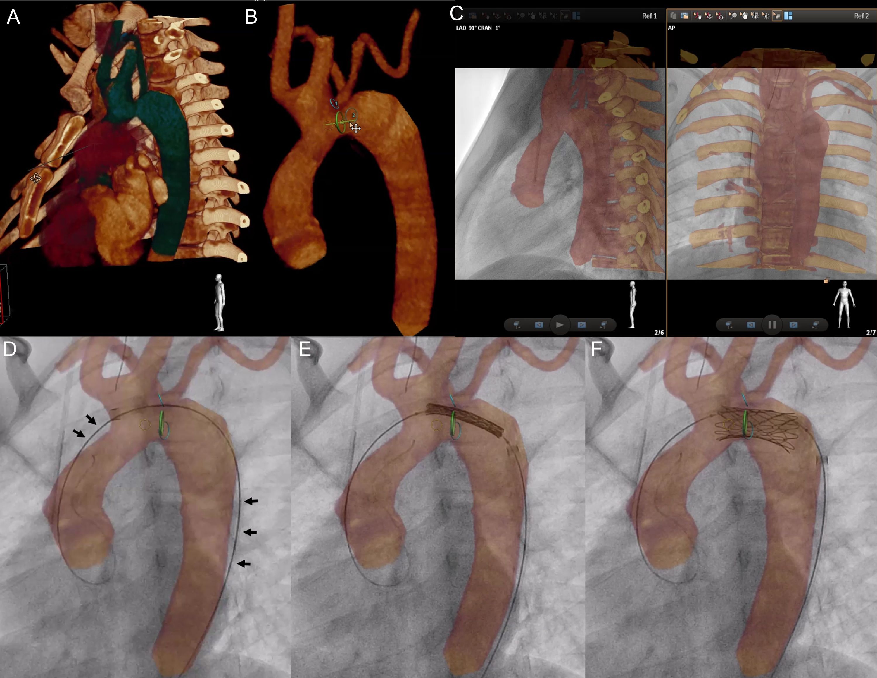 Three-dimensional Image Fusion of Precatheter CT and MRI Facilitates ...