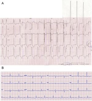 Electrocardiographic findings in 2 patients with Danon disease. A, ECG in a 14-year-old male patient with severe ventricular hypertrophy and preexcitation. The ECG was recorded at half voltage. B, ECG of a 23-year-old male patient, with no preexcitation and no signs of ventricular hypertrophy. ECG, electrocardiogram.