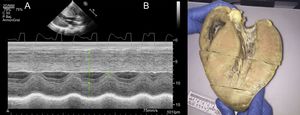 M-mode echocardiography image (A) and macroscopic image (B) of the heart of a 14-year-old male patient with Danon disease featuring severe left ventricular hypertrophy (interventricular septum, 43mm). Macroscopic image courtesy of Dr. Elena Ruiz, Hospital de la Paz, Madrid.