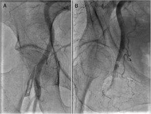 Right femoral angiography before (A) and after (B) transfemoral transcatheter aortic valve implantation demonstrating a localized femoral artery dissection. An excellent outcome was achieved with stenting via the left femoral artery using a crossover technique.