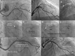 A: Calcified, tortuous circumflex artery with distal, medial, and proximal lesions (asterisks). B: The intravascular ultrasound (IVUS) catheter could not be advanced. C: Application of the side-branch anchor technique did not allow advancement of the lithoplasty balloon. D: Underexpansion of the 2.5-mm noncompliant (NC) balloon in the medial area helped advance the catheter extender and move the lithoplasty balloon forward (E). E: Unsuccessful dilation with 40 pulses. F: Opening of lesion after 60 pulses. G: Outcome after placement of 4 drug-eluting stents (DES).