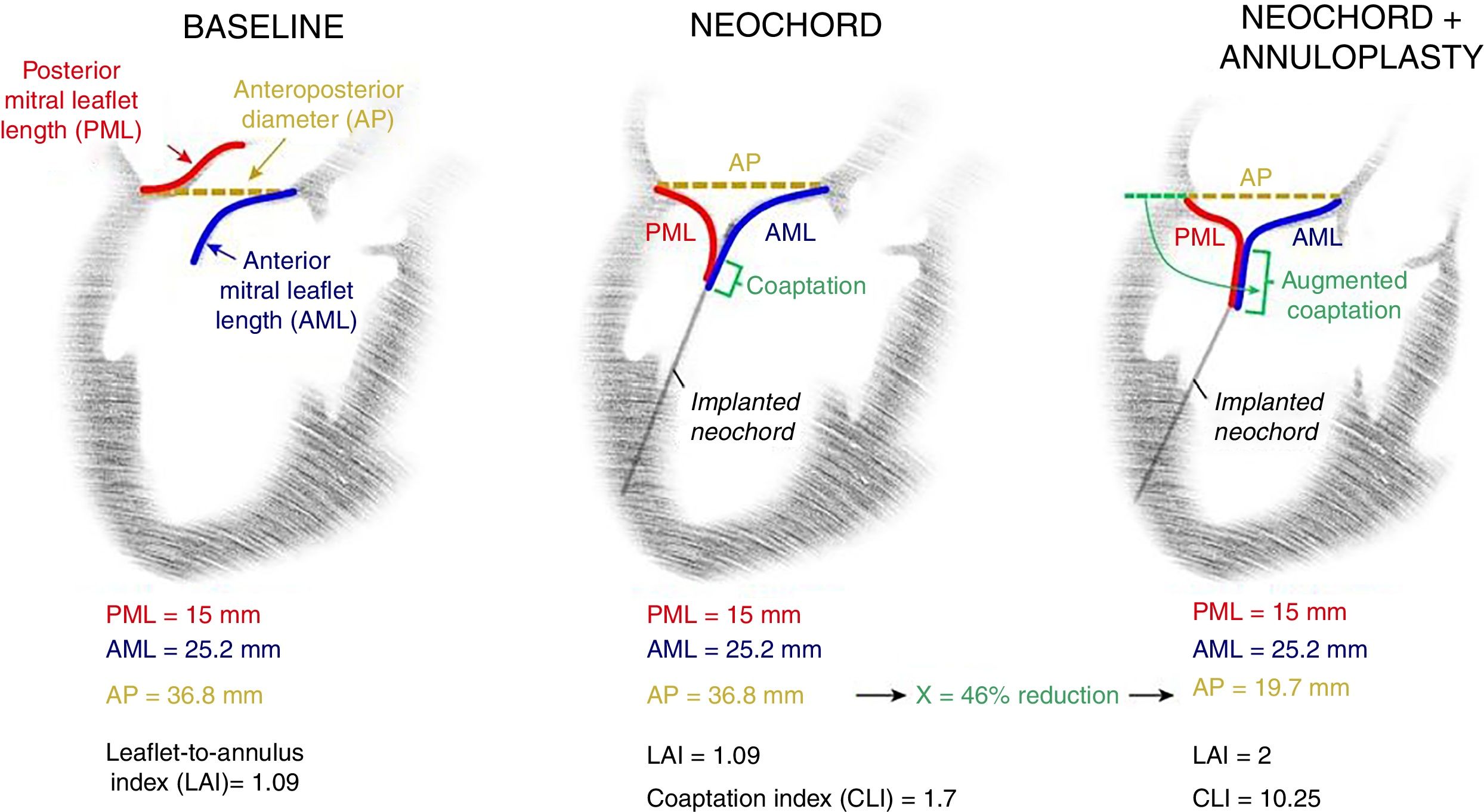 Transcatheter Mitral Valve Repair: Single Stage Combo Approach ...