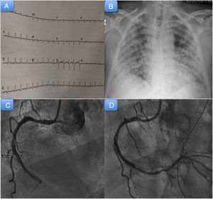A: admission electrocardiogram. B: admission chest radiograph. C: coronary angiogram showing thrombotic occlusion of the medial-distal segment of the right coronary artery. D: coronary angiogram showing occlusion of the posterior descending artery after migration of the thrombus.