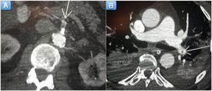 A: computed tomography (CT) scan of the abdomen showing a filling defect in the superior mesenteric artery consistent with arterial thrombosis (arrow). B: CT scan of the chest showing findings consistent with pulmonary thromboembolism (arrow).