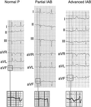 Examples of normal P wave and partial and advanced interatrial block (IAB). Adapted with permission from Martínez-Sellés et al.18
