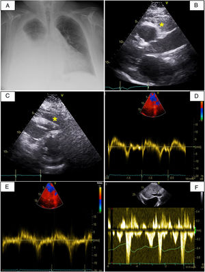 A, Posteroanterior chest radiograph showing pleural effusion in the right hemithorax. B and C, Two-dimensional parasternal transthoracic echocardiogram in short-axis (B) and long-axis (C) views showing abundant epicardial fat (asterisks). D and E, Tissue Doppler imaging of the lateral (D) and medial (E) mitral annulus showing annulus reversus with a longer medial e’ (15cm/s) than lateral e’ (8cm/s). F, Diastolic flow reversal in the hepatic veins on Doppler echocardiogram.