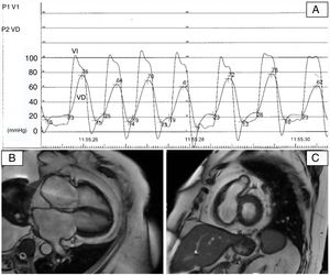 A, Cardiac catheterization showing a left ventricular dip and plateau pattern with elevation and equalization of end-diastolic pressures in both ventricles. B and C, Steady-state free precession cardiac magnetic resonance imaging 4-chamber view (B) and short-axis (C) showing abundant epicardial fat accumulation.
