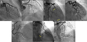 Characteristic angiographic findings in patients with spontaneous coronary artery dissection. A: double-lumen image in marginal branch (asterisks). B: possible intramural hematoma (type 2a lesion) (white arrow), with recovery of normal artery diameter distal to the lesion. C: long intramural hematoma (type 2b lesion) (within yellow arrows) in anterior descending artery extending to the distal tip of the coronary artery. D: focal type 3 lesion in marginal branch (white arrow). E: hematoma in distal segment of posterior descending artery with stick image morphology (+). F: hematoma in distal segment of anterior descending artery with radish morphology (yellow arrow). G: intramural hematoma in marginal branch with correction of normal coronary angle, causing the appearance of a broken line (shown in ellipse).