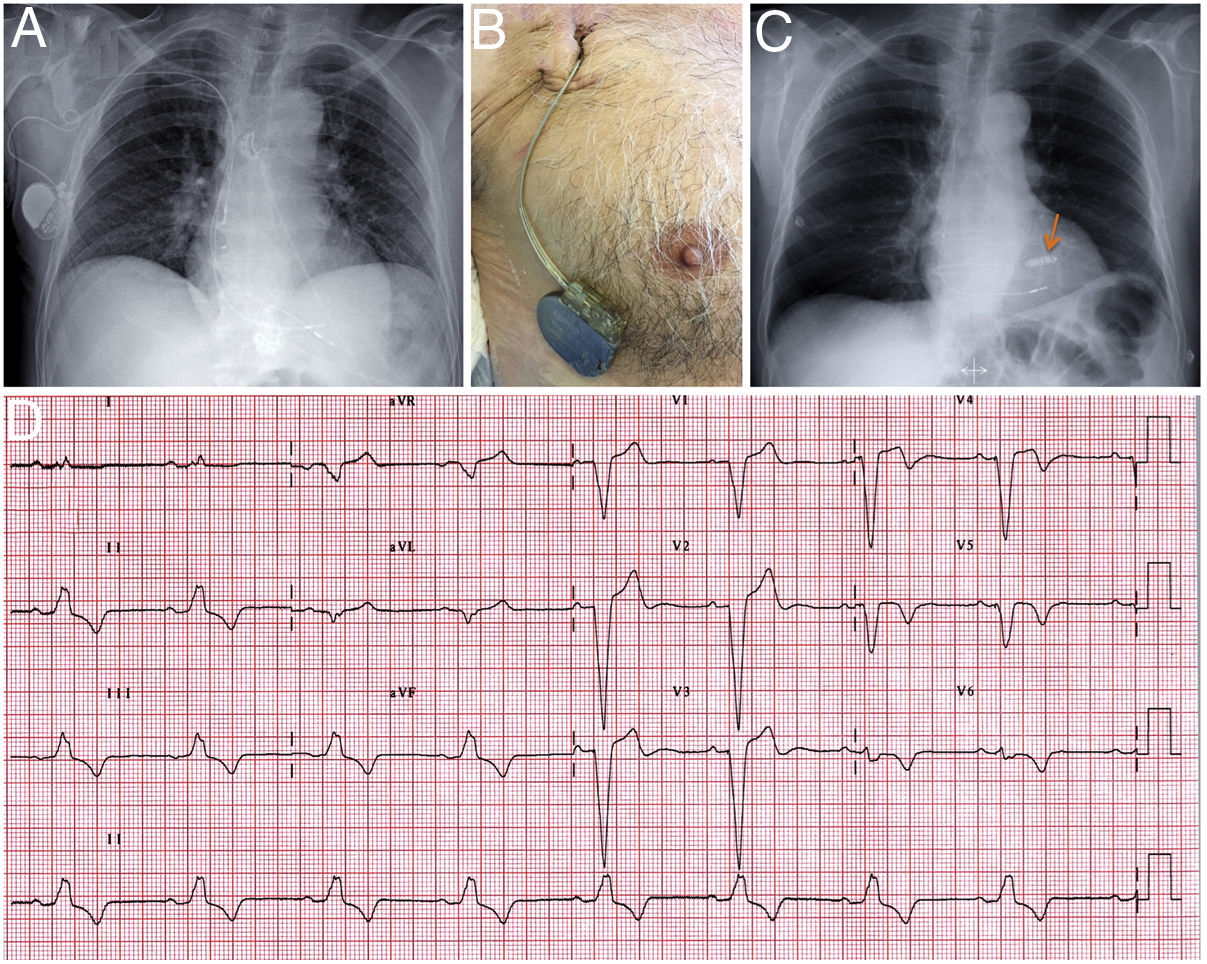 Leadless pacemakers for atrioventricular synchronous pacing | Revista ...