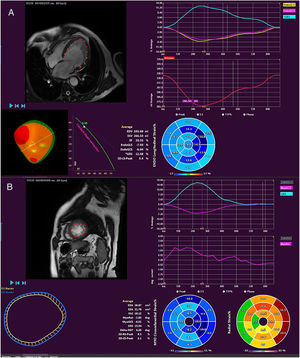 Determination of myocardial strain using feature tracking. In these longitudinal projections (A), the global longitudinal and circumferential strain can be determined and the radial strain inferred, as well volumes and ejection fractions, whereas, in the short axis (B), the global circumferential and radial strain can be measured and data obtained on myocardial torsion.