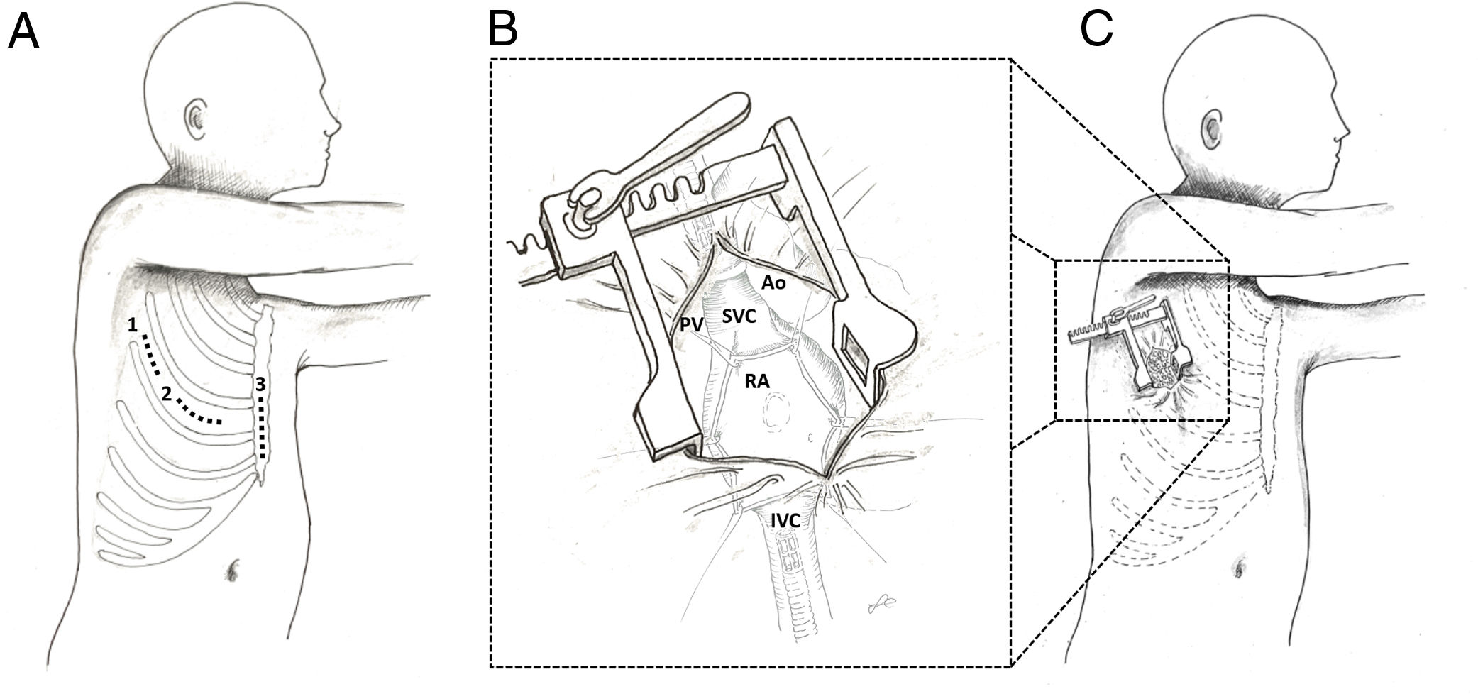 Changes in minimally invasive congenital cardiac surgery. Moving away ...