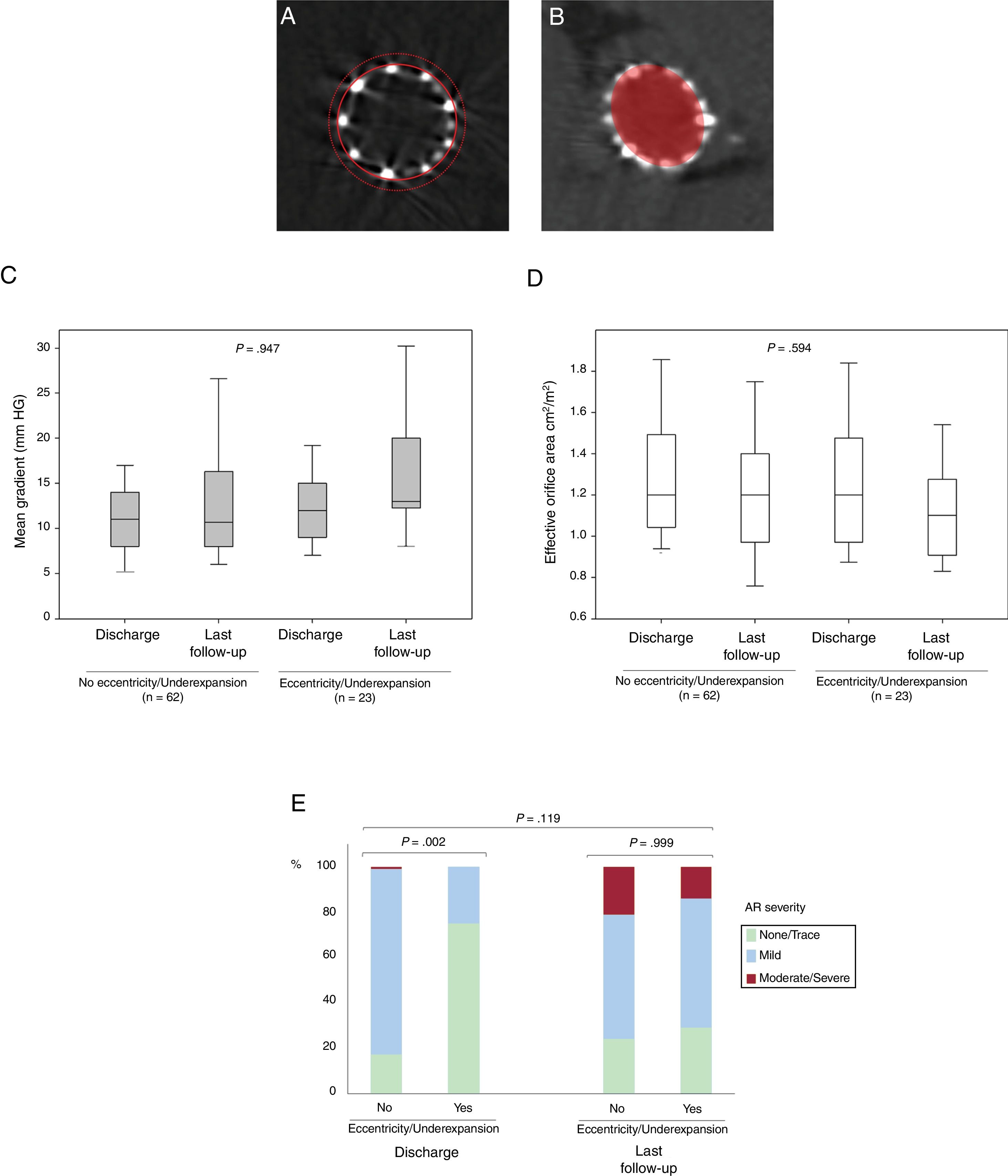 Multimodality evaluation of transcatheter structural valve degeneration ...