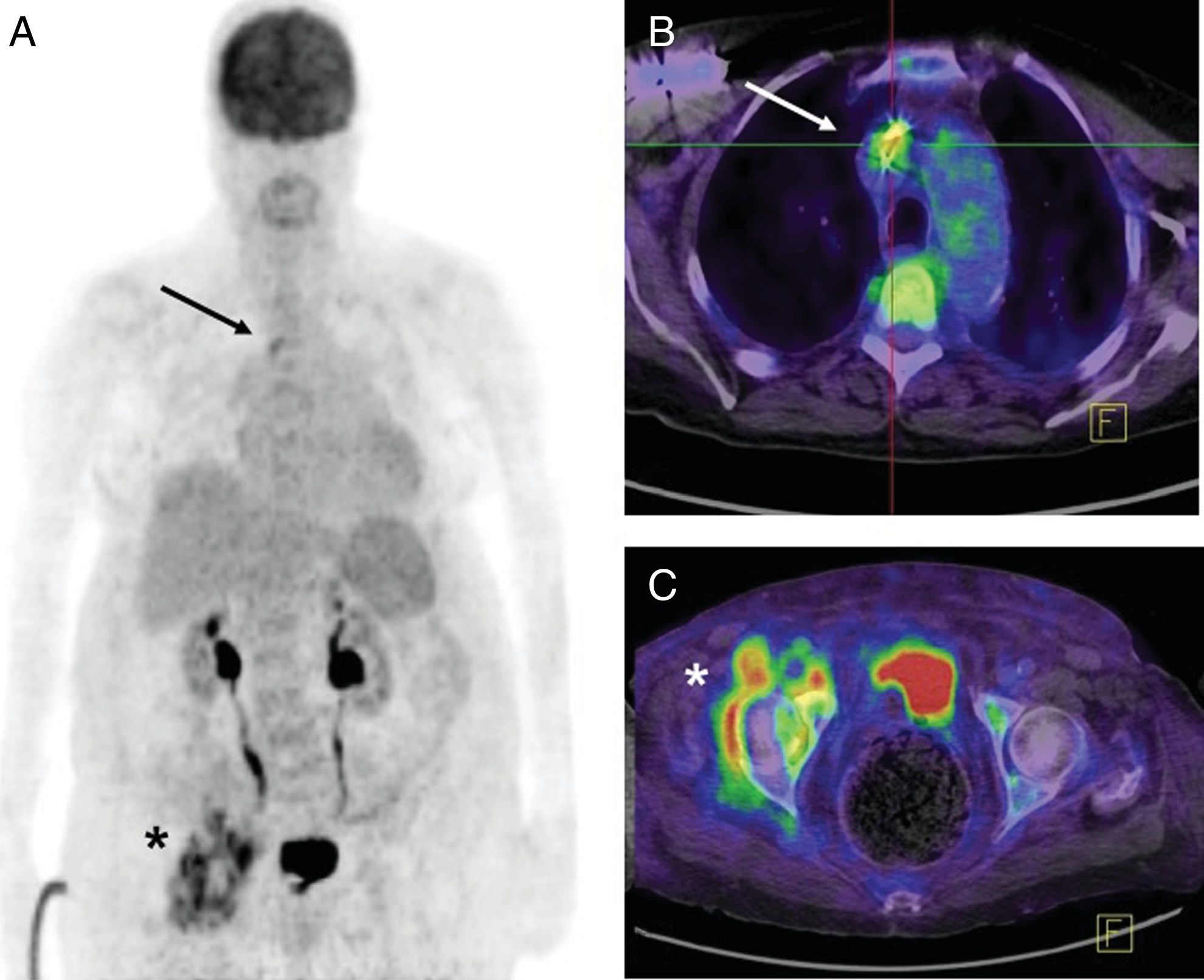 PET/CT with 18F-FDG in suspected intracardiac device-related infections ...
