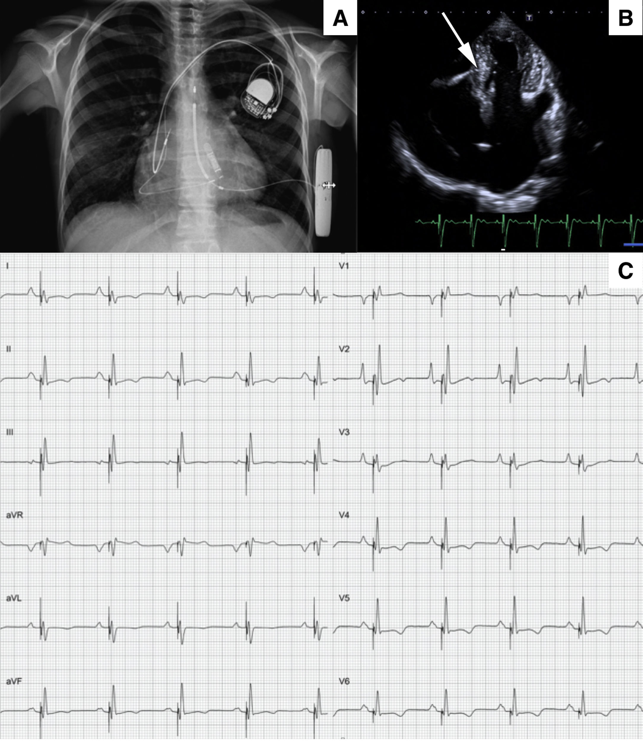 Combined use of subcutaneous implantable defibrillator with endovenous ...
