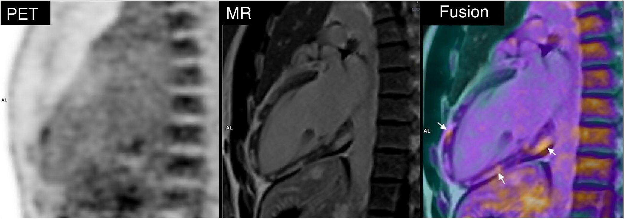 Additional value of hybrid PET/MR imaging versus MR or PET performed ...