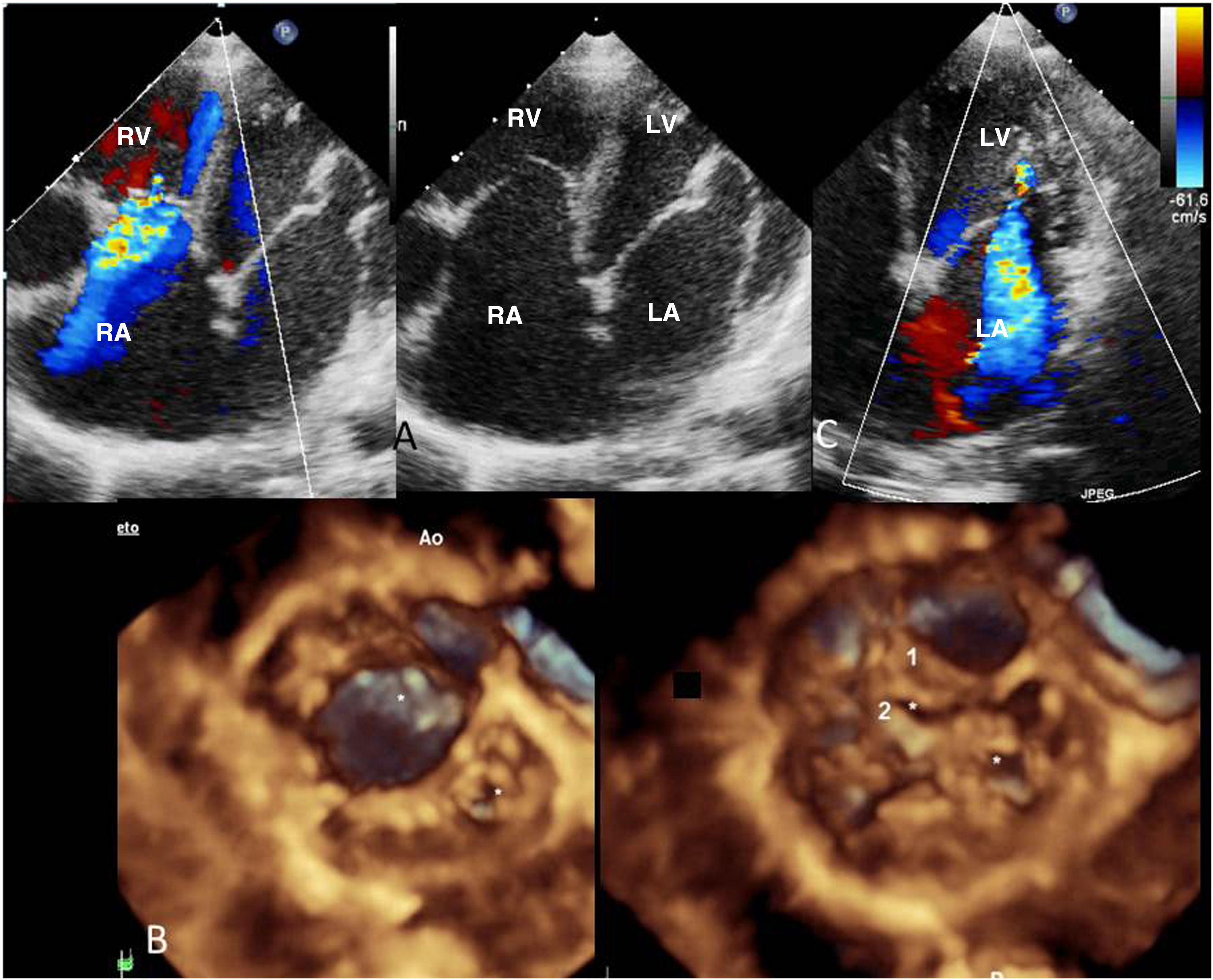 Uncommon mitral valve anomalies associated with Ebstein anomaly ...