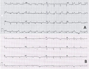 A: electrocardiogram showing sinus rhythm with a reduced PR interval in I and V5-V6 and diffuse ST elevation with upward concavity. B: electrocardiogram in sinus rhythm with < 1mm elevation and upward concavity in V3-V6 and negative T waves in I, II, aVL, and V3-V6.