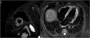 Magnetic resonance image with late enhancement in the lateral mediastinal region and edema on T2-enhanced STIR sequences.