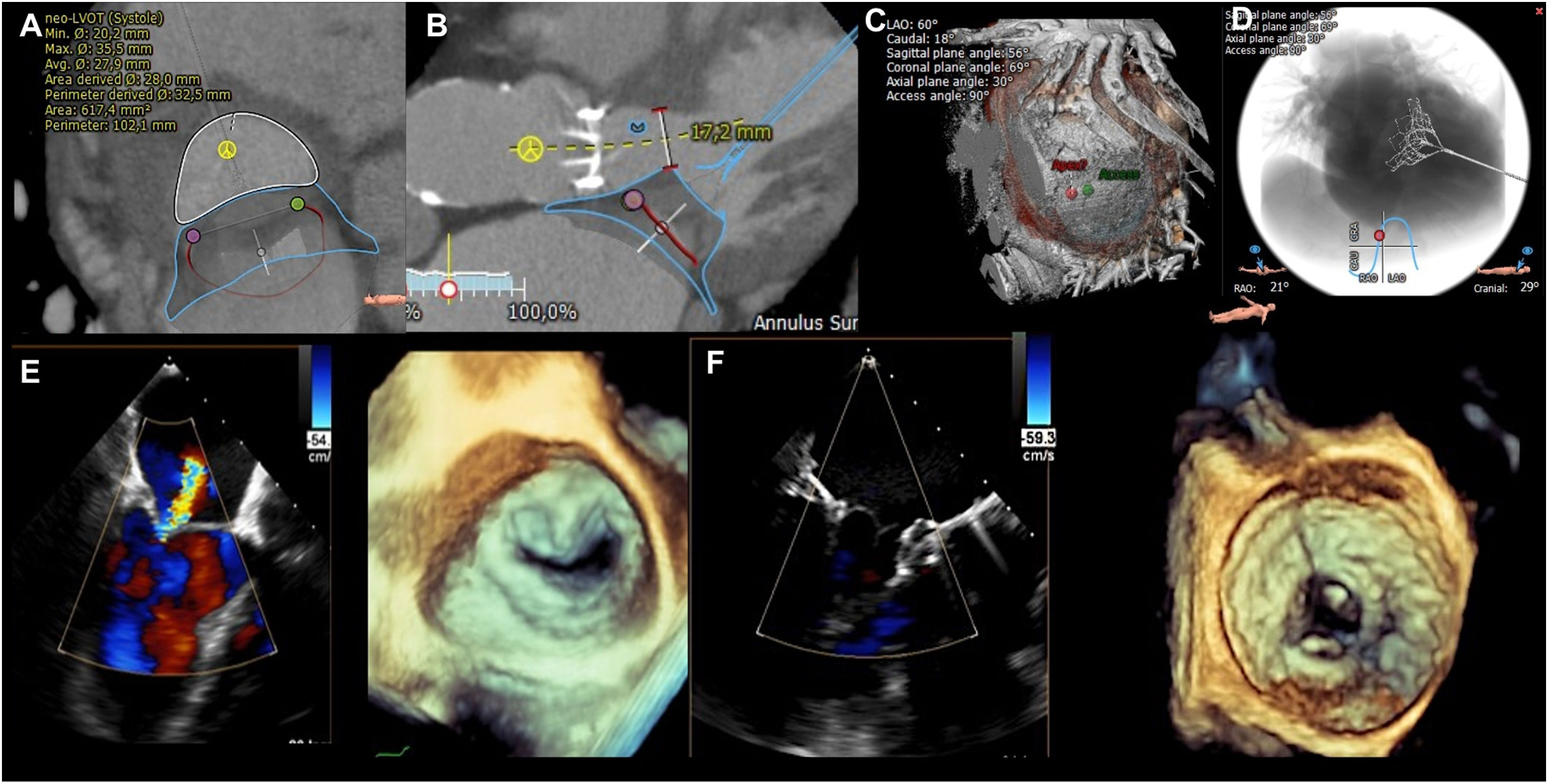 Transcatheter mitral valve replacement with Tendyne: first experience ...