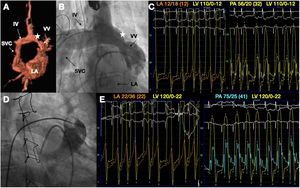 A: volume rendering 3D cardiac magnetic resonance images showed the partial ligation of the VV (star). B: angiography showed the same structures. C: preprocedure hemodynamic assessment. D: angiogram showing the transient balloon test occlusion of the VV. E: hemodynamic data demonstrated the increase in LA, LV, and PA pressures after balloon test occlusion. IV, innominate vein; LA, left atrium; LV, left ventricle; PA, pulmonary artery; SVC, superior vena cava; VV, vertical vein.
