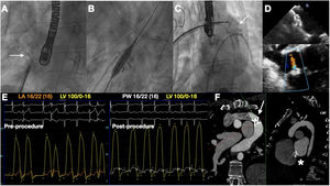A: the arrow marks the 8-mm AFR device implanted in the interatrial septum. B: dilatation with an 8-mm high pressure balloon. C: angiogram showing the VV closure with an 18-mm AmVSD (arrow). D: echocardiogram demonstrating the AFR device correctly implanted on the top, and on the bottom a restrictive flow between the atria through the AFR. E: final hemodynamic result without the increase in LA pressure or pulmonary wedge pressure. F: 2-year-follow-up computed tomography images showing the AmVSD occluding the VV (arrow) and the patent AFR (asterisk). AFR, atrial flow regulator; AmVSD, Amplatzer muscular ventricular septal defect occluder.