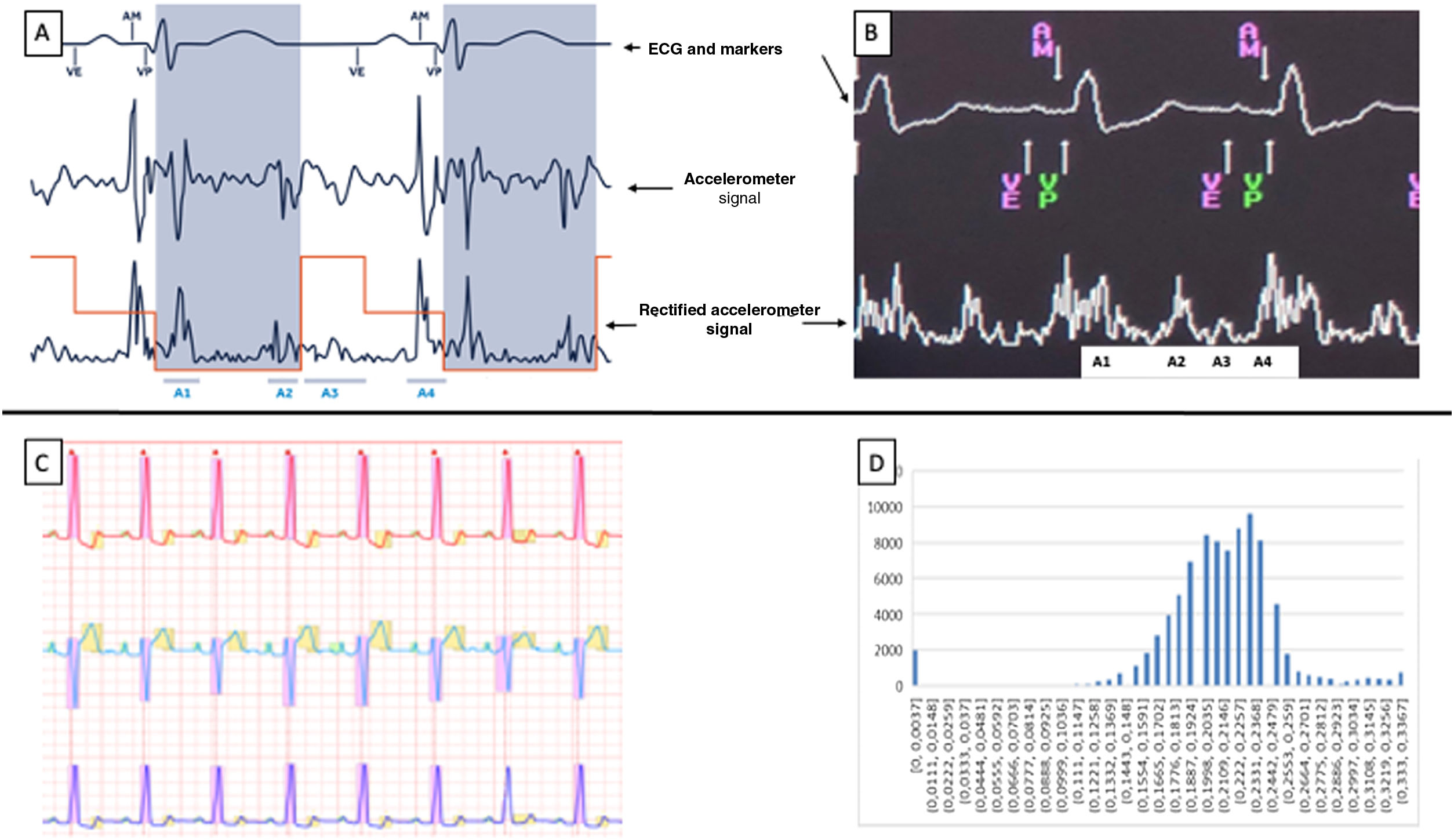 Leadless atrioventricular synchronous pacing: a validation pilot study ...
