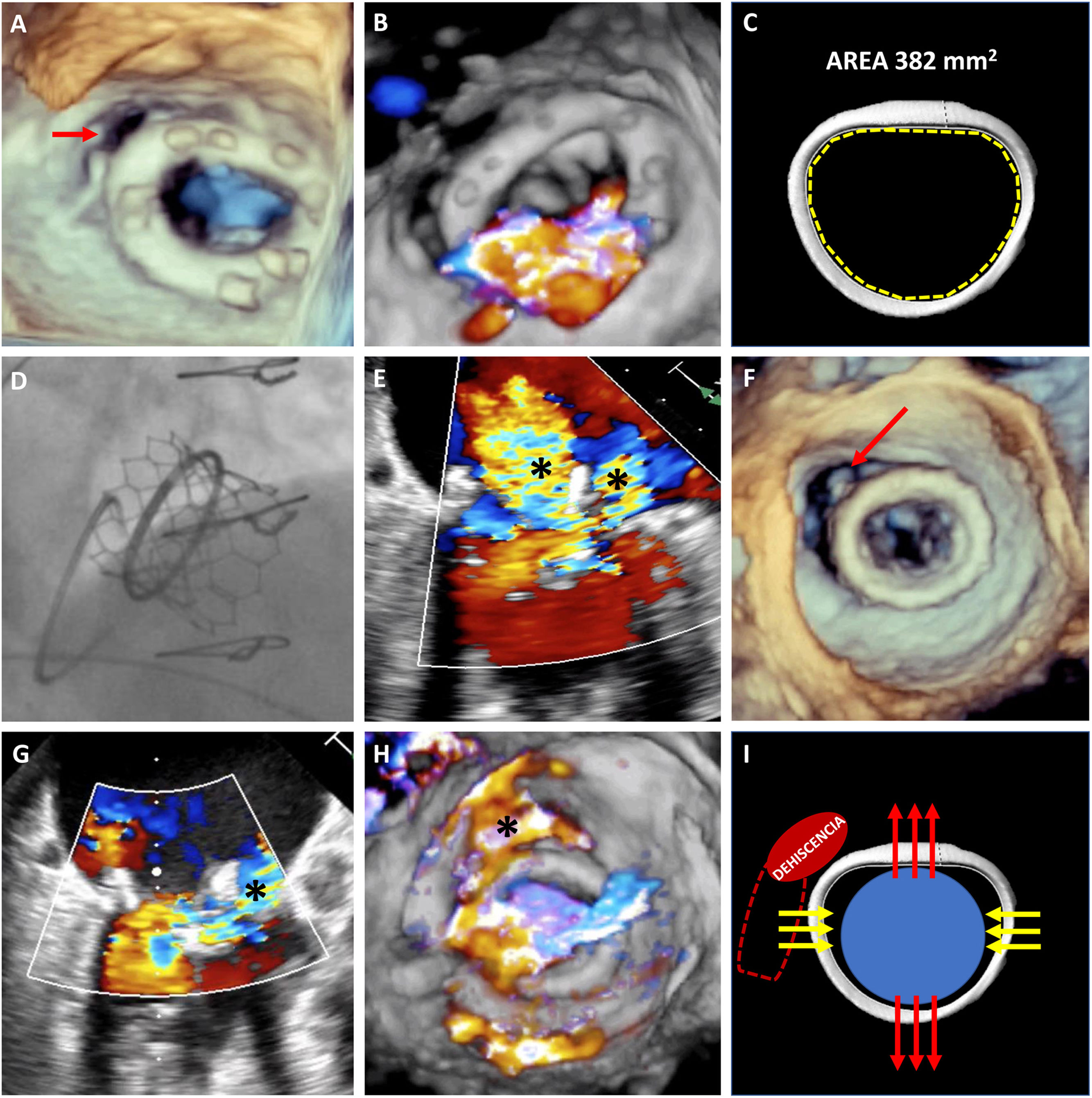 Prosthetic ring dehiscence during mitral valve-in-ring - Revista ...
