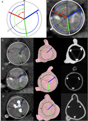 Cross-sectional images of pre-TAVI computed tomography scans summarizing the measurements for the evaluation of the degree of commissural misalignment. A, black line represents the right coronary ostium oriented at 12 o’clock; dashed line represents the left coronary ostium; blue line represents commissure between noncoronary sinus and right coronary sinus; red line represents the commissure between left coronary sinus and right coronary sinus; green line represents the commissure between left coronary sinus and noncoronary sinus. The arrows represent the 3 angles defined by right coronary and each commissure. B, previous scheme overlaid in a cross-sectional pre-TAVI scan. C, D* and E, pre-TAVI computed tomography scans showing the native aortic valve commissures (column 1), in silico (column 2) and in vitro (column 3) post-TAVI simulated implant with neo-commissural alignment, for cases 3, 4, and 5, respectively. *In silico ACURATE neo stent frame is represented in green.