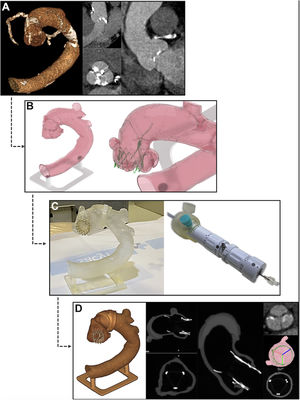 Step-by-step summary of the calculation of accurate neo-commissural alignment orientation before the in vivo procedure. A, pre-TAVI computed tomography images. B, in silico simulated prosthesis implant with accurate commissural alignment. C, in vitro implant with accurate commissural alignment in a 3D printed model from the patient by rotating the delivery system as estimated in silico and assisted with the dedicated rotational tool. D, computed tomography scan of 3D printed model after prosthesis implantation verifying the achievement of accurate commissural alignment as intended.