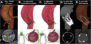 Case analysis and result after accurate commissural alignment from simulation to in vivo. A, native aortic valve in baseline computed tomography scan; B,C, in silico conventional and ACA oriented implant; D, computed tomography scan of 3D printed model with ACA oriented implant; E, computed tomography scan following ACA oriented ACURATE neo prosthesis implant. ACA, accurate commissural alignment; CT, computed tomography; pre-TAVR CT scan, computed tomograhy performed for plannification of transcatether aortic valve replacement; THV, transcatheter heart valve.