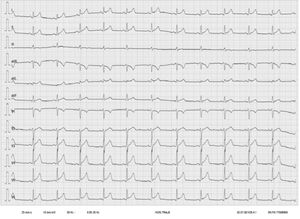 Electrocardiogram showing sinus rhythm with a diffuse concave ST segment elevation (> 1 mm) and a PR segment elevation in lead aVR.