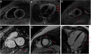 T2-weighted STIR images in short-axis (A and B) and 4-chamber (C) views. Hyperintensities related to edema are seen in the basal inferior and lateral segments, the mid-lateral segment, and the apical anterior, lateral, and inferior segments (arrows and arrowheads). Delayed enhancement images in the short-axis (D and E) and 4-chamber views (F). Patchy late gadolinium enhancement is seen in the subepicardial myocardium (arrows).