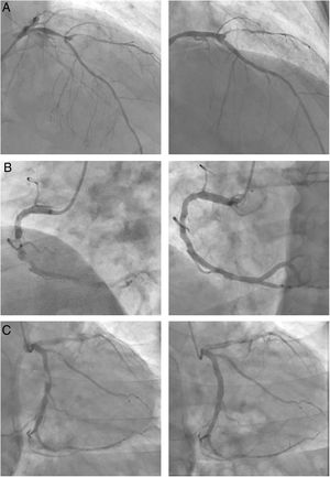 Images on the right show the final results of the 3 revascularizations. A: bifurcated lesion in the mid-left anterior descending artery involving the origin of the diagonal, with an aneurysm between branches. B: chronic suboclusion in the mid-right coronary artery, which was highly calcified, eccentric and diffuse. C: severely eccentric and tubular lesion in the proximal circumflex.