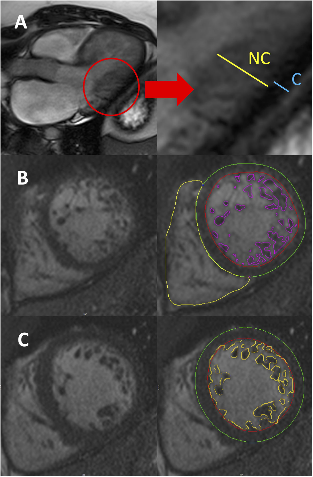 Noncompaction Cm Left ventricular noncompaction: a disease or a phenotypic trait ...