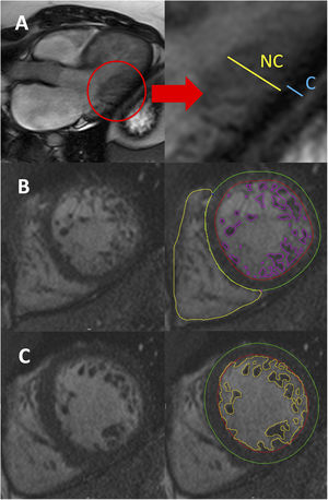 Left ventricular noncompaction diagnostic criteria with cardiovascular magnetic resonance. A: measurement of the wall thickness of the compacted (C) and noncompacted (NC) myocardial layers on a longitudinal-axis view at end-diastole (Petersen criteria). B: endocardial (red) and epicardial (green) contours, including semiautomatic outlining of the trabeculae (purple) for trabeculated mass quantification, in a short-axis view (Jacquier criteria). C: endocardial (red) and epicardial (green) contours, including the automatic outlining of the trabeculae (yellow) for fractal analysis, in a short-axis view (Captur criteria).