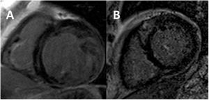 Cardiovascular magnetic resonance post-contrast T1 images showing different late gadolinium enhancement patterns in left ventricular noncompaction. A: linear intramyocardial basal septum uptake. B: focal intramyocardial basal anteroseptal uptake.