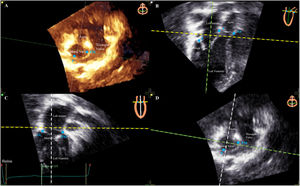 Step 4: Landmarks of the mitral valve on TTE. A: 3D TTE corresponding to panel D. B: apical 3-chamber view. C: apical 2-chamber view. D: short axis view. The blue spots are the landmarks (A, anterior; P, posterior; Ao, aorta; AL, anterolateral; PM, posteromedial) to be placed on panels B and C according to the reference image at the top right of each panel. TTE, transthoracic echocardiography.