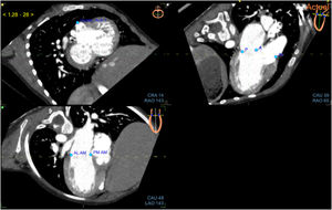(central illustration). Navigation in fusion imaging in a patient with a double outlet right ventricle. A: CT mitral valve alignment on the short axis, apical 3-chamber, and apical 2-chamber views. B: CT aortic valve alignment and landmarks on the horizontal, coronal, and sagittal views. C: CT tricuspid valve alignment and landmarks on the short axis, apical 2-chamber, and 4-chamber views. D: 3D TTE showing the double outlet right ventricle, alignment, and mitral valve landmarks. The patient had a double outlet right ventricle. Note the ventriculoarterial disposition with an anterior aorta and the doubly committed ventricular septal defect, absence of a conal septum between the great vessels, hypoplasia of the pulmonary annulus, and absence of straddling or overriding of the atrioventricular valves. CT, computed tomography; TTE, transthoracic echocardiography.