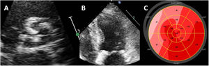 Evaluation of left ventricular systolic function with strain imaging in aortic stenosis. Example of a patient with calcific aortic stenosis. A: short-axis view of the tricuspid aortic valve, calcified, leading to severe hypertrophy of the left ventricle (B). Despite having normal left ventricular ejection fraction, left ventricular global longitudinal strain is impaired, particularly in the most hypertrophied left ventricular segments (C, septal).