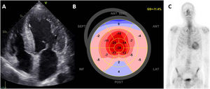Transthyretin cardiac amyloidosis in a patient with severe aortic stenosis. A: apical 4-chamber view with concentric hypertrophy of the left ventricle, thickened mitral leaflets and dilated atria. On echocardiographic strain analysis, the bull's eye plot of the left ventricle shows apical sparing with more preserved values of longitudinal strain in the apex (B). On bone-scintigraphy, there is uptake by the heart (C). GS, global strain.