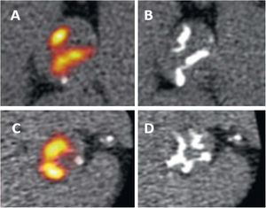18F-NaF positron emission tomography of 2 patients with calcific aortic stenosis. Panels A and C show the increased valvular 18F-NaF PET uptake at baseline, which predicted progression to macrocalcification on computed tomography after 2 years (B, D). Reproduced with permission from Zheng et al.50.