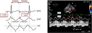 Normal hepatic vein waveform mirrors changes in CVP. CVP, central venous pressure; ECG, electrocardiogram tracing; HV, hepatic vein.