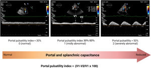 Portal pulsatility index. Normal portal vein waveform and alterations with venous congestion.