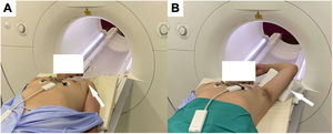 Preparation of a patient with an automatic implantable device in the left hemithorax for cardiothoracic MR. Increased distance between the generator and the scanning area through placement of an adhesive band (A) or with the arm ipsilateral to the device raised above the head (B).